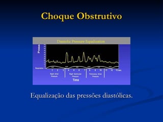 Choque Obstrutivo Equalização das pressões diastólicas. 