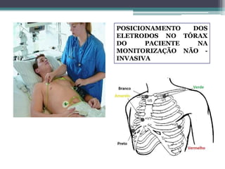 POSICIONAMENTO DOS
ELETRODOS NO TÓRAX
DO PACIENTE NA
MONITORIZAÇÃO NÃO -
INVASIVA
 