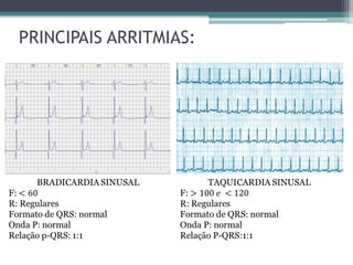 PRINCIPAIS ARRITMIAS:
 