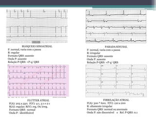BLOQUEIO SINOATRIAL
F: normal, varia com a pausa
R: regular
Formato QRS: ausente
Onda P: ausente
Relação P-QRS: +P q/ QRS
PARADA SINUSAL
F: normal, varia com a pausa
R: irregular
Formato QRS: ausente
Onda P: ausente
Relação P-QRS: +P q/ QRS
FLUTTER ATRIAL
F(A): 205 a 350; F(V): 4:1, 3:1 e 2:1
R(A): regular; R(V): reg. Ou irreg.
Formato QRS: normal
Onda P: identificável
FIBRILAÇÂO ATRIAL
F(A): 300 ª 600; F(V): 120 a 200
R: altamente irregular
Formato QRS: normal ou anormais
Onda P: não discernível e Rel. P-QRS: n:1
 