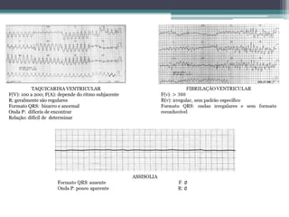 TAQUICARDIA VENTRICULAR
F(V): 100 a 200; F(A): depende do ritmo subjacente
R: geralmente são regulares
Formato QRS: bizarro e anormal
Onda P: difíceis de encontrar
Relação: difícil de determinar
 