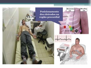 Posicionamento
dos eletrodos na
região precordial
 