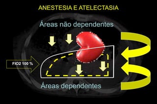 ANESTESIA E ATELECTASIA

             Áreas não dependentes




FIO2 100 %




             Áreas dependentes
 