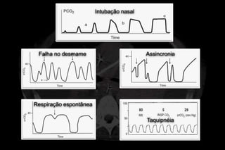 Intubação nasal




 Falha no desmame                         Assincronia




Respiração espontânea

                                          Taquipnéia
 