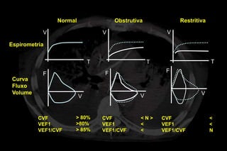 Normal                Obstrutiva             Restritiva

           V                     V                      V

Espirometria


                             T                     T                      T

                                  F                     F
           F
 Curva
 Fluxo
 Volume                                                              V
                         V                     V


          CVF        > 80%       CVF           <N>     CVF                <
          VEF1       >80%        VEF1          <       VEF1               <
          VEF1/CVF   > 85%       VEF1/CVF      <       VEF1/CVF           N
 