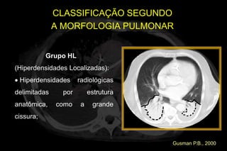 CLASSIFICAÇÃO SEGUNDO
              A MORFOLOGIA PULMONAR


           Grupo HL
(Hiperdensidades Localizadas):
 Hiperdensidades      radiológicas
delimitadas     por        estrutura
anatômica,    como     a    grande
cissura;


                                       Gusman P.B., 2000
 