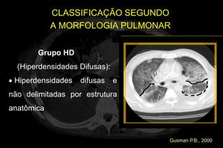 CLASSIFICAÇÃO SEGUNDO
             A MORFOLOGIA PULMONAR


       Grupo HD
  (Hiperdensidades Difusas):
 Hiperdensidades   difusas     e
não delimitadas por estrutura
anatômica;



                                   Gusman P.B., 2000
 
