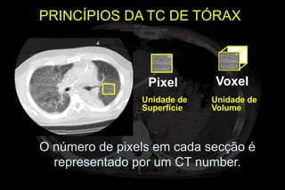 PRINCÍPIOS DA TC DE TÓRAX



                 Pixel       Voxel
                Unidade de   Unidade de
                Superfície   Volume



O número de pixels em cada secção é
  representado por um CT number.
 