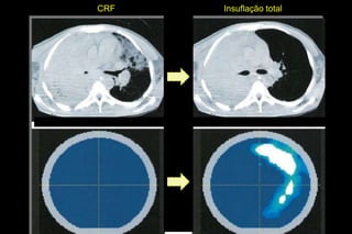 CRF   Insuflação total
 