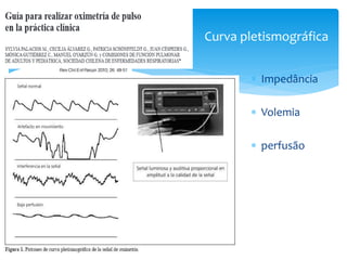  Impedância
 Volemia
 perfusão
Curva pletismográfica
 
