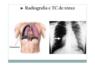 Radiografia e TC de tórax
 