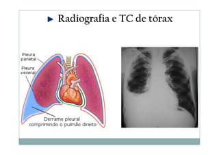Radiografia e TC de tórax
 