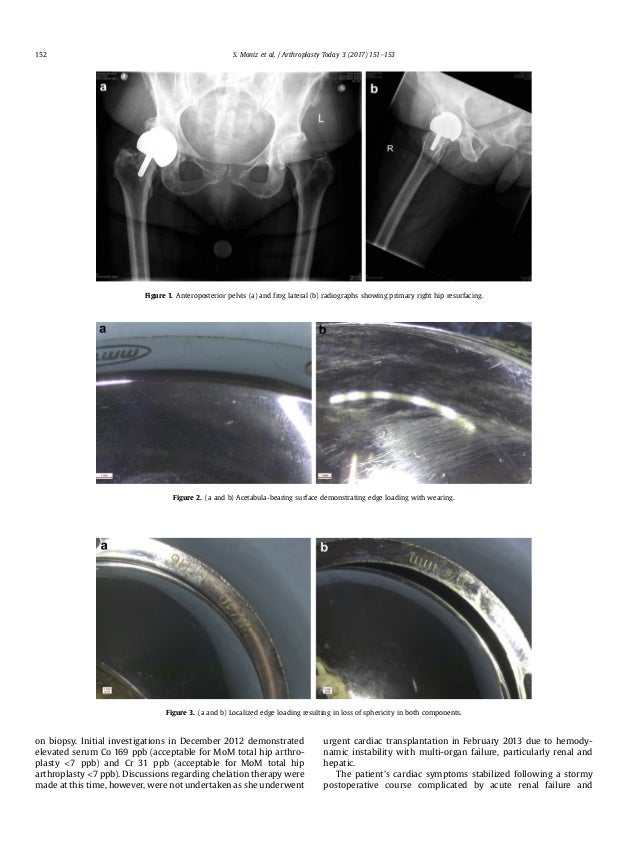 Cardiac transplant due to metal toxicity associated with hip arthropl…