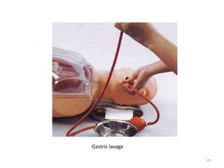 29
Gastric lavage
 