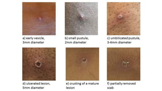 Clinical Manifistations
 