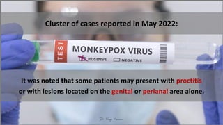 Cluster of cases reported in May 2022:
It was noted that some patients may present with proctitis
or with lesions located on the genital or perianal area alone.
 