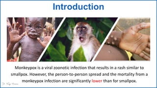 Introduction
Monkeypox is a viral zoonotic infection that results in a rash similar to
smallpox. However, the person-to-person spread and the mortality from a
monkeypox infection are significantly lower than for smallpox.
 
