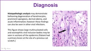 Diagnosis
Histopathologic analysis may demonstrate
ballooning degeneration of keratinocytes,
prominent spongiosis, dermal edema, and
acute inflammation; however these findings
can also be seen in other viral infections.
This figure shows large multinucleated cells
and eosinophilic viral inclusion bodies may be
seen in sections of the epidermis (Patient had
a primary lesion at the site of a previous cat
scratch.)
 