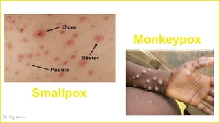 Smallpox
Monkeypox
 