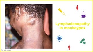 Lymphadenopathy
in monkeypox
 