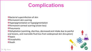 Complications
Bacterial superinfection of skin
Permanent skin scarring
Hyperpigmentation or hypopigmentation
Permanent corneal scarring (vision loss)
Pneumonia
Dehydration (vomiting, diarrhea, decreased oral intake due to painful
oral lesions, and insensible fluid loss from widespread skin disruption)
Sepsis
Encephalitis
Death
 