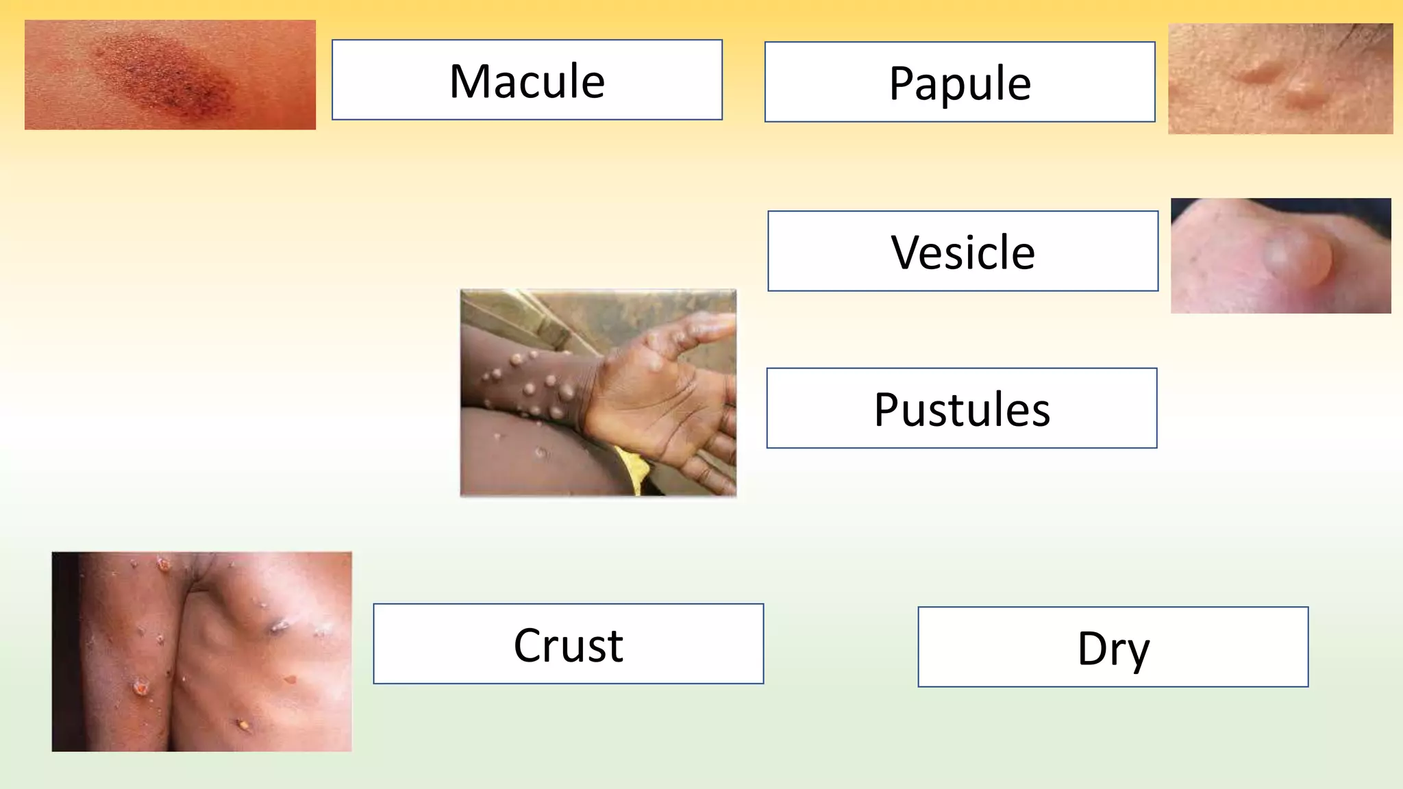 Monkeypox | PPTX