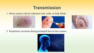 Transmission
1. Direct contact with the infectious rash, scabs, or body fluids,
2. Respiratory secretions during prolonged face-to-face contact,
 
