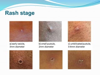Rash stage
 