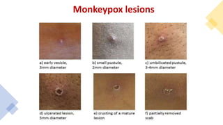 Monkeypox lesions
 
