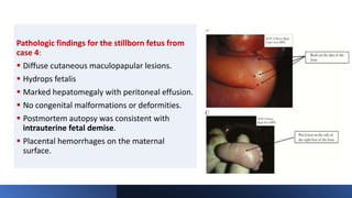 Pathologic findings for the stillborn fetus from
case 4:
 Diffuse cutaneous maculopapular lesions.
 Hydrops fetalis
 Marked hepatomegaly with peritoneal effusion.
 No congenital malformations or deformities.
 Postmortem autopsy was consistent with
intrauterine fetal demise.
 Placental hemorrhages on the maternal
surface.
 