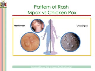 Roseola Rash Vs Chickenpox Rash Monkey Pox slides; Get to learn the risk factors,presentation and ...