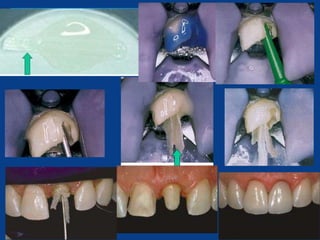 Monoblation Design dental Monoblock obturation technique or concept in endodontics | PPTX