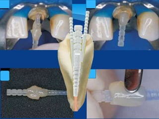 Monoblation Design dental Monoblock obturation technique or concept in endodontics | PPTX
