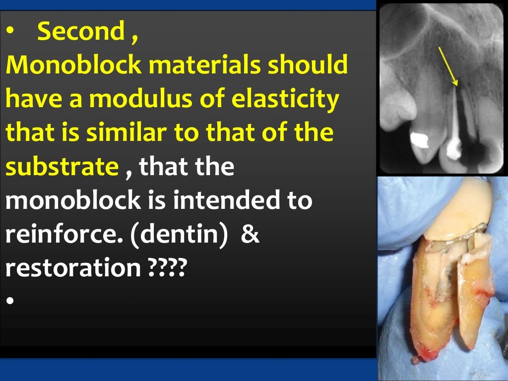 dental Monoblock obturation technique or concept in endodontics