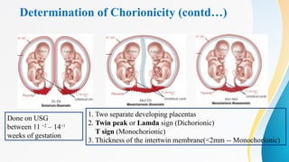 Determination of Chorionicity (contd…)
Done on USG
between 11 +2
– 14+1
weeks of gestation
1. Two separate developing placentas
2. Twin peak or Lamda sign (Dichorionic)
T sign (Monochorionic)
3. Thickness of the intertwin membrane(<2mm -- Monochorionic)
 