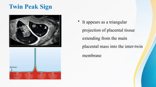 Twin Peak Sign
• It appears as a triangular
projection of placental tissue
extending from the main
placental mass into the inter-twin
membrane
 