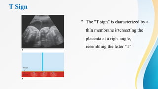 T Sign
• The "T sign" is characterized by a
thin membrane intersecting the
placenta at a right angle,
resembling the letter "T"
 
