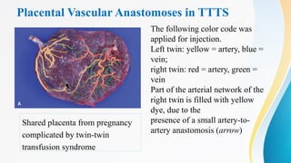 Placental Vascular Anastomoses in TTTS
The following color code was
applied for injection.
Left twin: yellow = artery, blue =
vein;
right twin: red = artery, green =
vein
Part of the arterial network of the
right twin is filled with yellow
dye, due to the
presence of a small artery-to-
artery anastomosis (arrow)
Shared placenta from pregnancy
complicated by twin-twin
transfusion syndrome
 