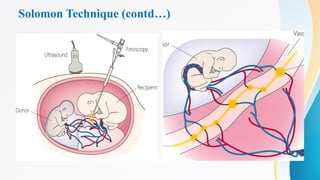 Solomon Technique (contd…)
 