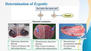 Determination of Zygosity
Placental examination
• Dichorionic diamniotic
placenta
• 2 layers of amnions with
intervening chorion
• Monochorionic diamniotic
placenta
• Only 2 layers of amnions
without intervening chorion
• Monochorionic
monoamniotic placenta
• No intervening
membrane
 
