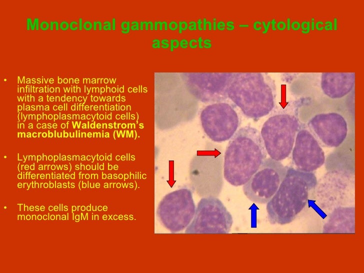 Monoclonal Gammopathies