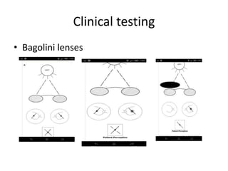 Clinical testing
• Bagolini lenses
 