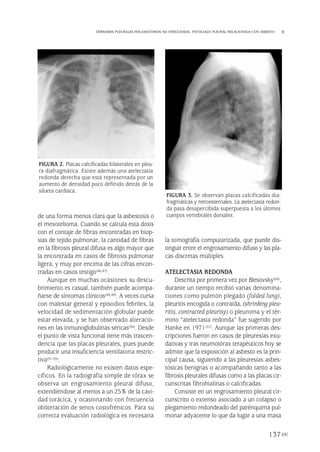 de una forma menos clara que la asbestosis o
el mesotelioma. Cuando se calcula esta dosis
con el contaje de fibras encontradas en biop-
sias de tejido pulmonar, la cantidad de fibras
en la fibrosis pleural difusa es algo mayor que
la encontrada en casos de fibrosis pulmonar
ligera, y muy por encima de las cifras encon-
tradas en casos testigo(46,47).
Aunque en muchas ocasiones su descu-
brimiento es casual, también puede acompa-
ñarse de síntomas clínicos(48,49). A veces cursa
con malestar general y episodios febriles, la
velocidad de sedimentación globular puede
estar elevada, y se han observado alteracio-
nes en las inmunoglobulinas séricas(50). Desde
el punto de vista funcional tiene más trascen-
dencia que las placas pleurales, pues puede
producir una insuficiencia ventilatoria restric-
tiva(51-55).
Radiológicamente no existen datos espe-
cíficos. En la radiografía simple de tórax se
observa un engrosamiento pleural difuso,
extendiéndose al menos a un 25% de la cavi-
dad torácica, y ocasionando con frecuencia
obliteración de senos costofrénicos. Para su
correcta evaluación radiológica es necesaria
la tomografía computarizada, que puede dis-
tinguir entre el engrosamiento difuso y las pla-
cas discretas múltiples.
ATELECTASIA REDONDA
Descrita por primera vez por Blesovsky(56),
durante un tiempo recibió varias denomina-
ciones como pulmón plegado (folded lung),
pleuritis encogida o contraída, (shrinking pleu-
ritis, contracted pleurisy) o pleuroma y el tér-
mino “atelectasia redonda” fue sugerido por
Hanke en 1971(57). Aunque las primeras des-
cripciones fueron en casos de pleuresías exu-
dativas y tras neumotórax terapéuticos hoy se
admite que la exposición al asbesto es la prin-
cipal causa, siguiendo a las pleuresías asbes-
tósicas benignas o acompañando tanto a las
fibrosis pleurales difusas como a las placas cir-
cunscritas fibrohialinas o calcificadas.
Consiste en un engrosamiento pleural cir-
cunscrito o extenso asociado a un colapso o
plegamiento redondeado del parénquima pul-
monar adyacente lo que da lugar a una masa
137
DERRAMES PLEURALES INFLAMATORIOS NO INFECCIOSOS. PATOLOGÍA PLEURAL RELACIONADA CON ASBESTO
FIGURA 2. Placas calcificadas bilaterales en pleu-
ra diafragmática. Existe además una atelectasia
redonda derecha que está representada por un
aumento de densidad poco definido detrás de la
silueta cardiaca.
FIGURA 3. Se observan placas calcificadas dia-
fragmáticas y retroesternales. La atelectasia redon-
da pasa desapercibida superpuesta a los últimos
cuerpos vertebrales dorsales.
Pleura 224p 9/7/13 10:23 Página 137
 