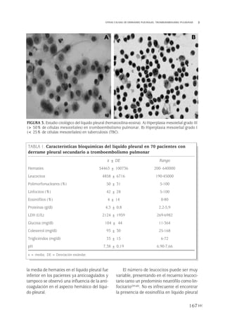 la media de hematíes en el líquido pleural fue
inferior en los pacientes ya anticoagulados y
tampoco se observó una influencia de la anti-
coagulación en el aspecto hemático del líqui-
do pleural.
El número de leucocitos puede ser muy
variable, presentando en el recuento leucoci-
tario tanto un predominio neutrófilo como lin-
focitario(59-60). No es infrecuente el encontrar
la presencia de eosinofilia en líquido pleural
167
OTRAS CAUSAS DE DERRAMES PLEURALES. TROMBOEMBOLISMO PULMONAR
FIGURA 3. Estudio citológico del líquido pleural (hematoxilina-eosina). A) Hiperplasia mesotelial grado III
(> 50% de células mesoteliales) en tromboembolismo pulmonar. B) Hiperplasia mesotelial grado I
(< 25% de células mesoteliales) en tuberculosis (TBC).
TABLA 1. Características bioquímicas del líquido pleural en 70 pacientes con
derrame pleural secundario a tromboembolismo pulmonar
x ± DE Rango
Hematíes 54463 ± 100736 200- 640000
Leucocitos 4858 ± 6716 190-45000
Polimorfonucleares (%) 50 ± 31 5-100
Linfocitos (%) 42 ± 28 5-100
Eosinófilos (%) 4 ± 14 0-80
Proteínas (g/dl) 4,3 ± 0,8 2,2-5,9
LDH (U/L) 2124 ± 1959 269-6982
Glucosa (mg/dl) 104 ± 44 11-364
Colesterol (mg/dl) 93 ± 30 25-168
Triglicéridos (mg/dl) 33 ± 15 6-72
pH 7,38 ± 0,19 6,90-7,66
x = media; DE = Desviación estándar.
A B
Pleura 224p 9/7/13 10:23 Página 167
 