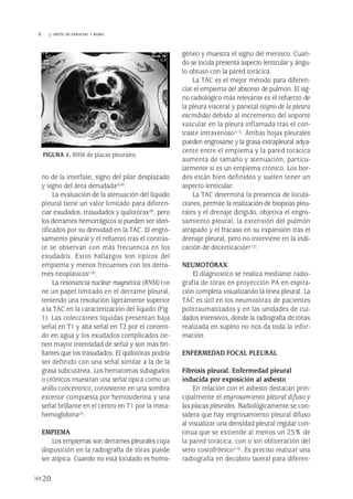 no de la interfase, signo del pilar desplazado
y signo del área denudada(5-8).
La evaluación de la atenuación del líquido
pleural tiene un valor limitado para diferen-
ciar exudados, trasudados y quilotórax(9), pero
los derrames hemorrágicos sí pueden ser iden-
tificados por su densidad en la TAC. El engro-
samiento pleural y el refuerzo tras el contras-
te se observan con más frecuencia en los
exudados. Estos hallazgos son típicos del
empiema y menos frecuentes con los derra-
mes neoplásicos(10).
La resonancia nuclear magnética (RNM) tie-
ne un papel limitado en el derrame pleural,
teniendo una resolución ligeramente superior
a la TAC en la caracterización del líquido (Fig.
1). Las colecciones líquidas presentan baja
señal en T1 y alta señal en T2 por el conteni-
do en agua y los exudados complicados tie-
nen mayor intensidad de señal y son más bri-
llantes que los trasudados. El quilotórax podría
ser definido con una señal similar a la de la
grasa subcutánea. Los hematomas subagudos
o crónicos muestran una señal típica como un
anillo concéntrico, consistente en una sombra
exterior compuesta por hemosiderina y una
señal brillante en el centro en T1 por la meta-
hemoglobina(2).
EMPIEMA
Los empiemas son derrames pleurales cuya
disposición en la radiografía de tórax puede
ser atípica. Cuando no está loculado es homo-
géneo y muestra el signo del menisco. Cuan-
do se locula presenta aspecto lenticular y ángu-
lo obtuso con la pared torácica.
La TAC es el mejor método para diferen-
ciar el empiema del absceso de pulmón. El sig-
no radiológico más relevante es el refuerzo de
la pleura visceral y parietal (signo de la pleura
escindida) debido al incremento del soporte
vascular en la pleura inflamada tras el con-
traste intravenoso(11). Ambas hojas pleurales
pueden engrosarse y la grasa extrapleural adya-
cente entre el empiema y la pared torácica
aumenta de tamaño y atenuación, particu-
larmente si es un empiema crónico. Los bor-
des están bien definidos y suelen tener un
aspecto lenticular.
La TAC determina la presencia de locula-
ciones, permite la realización de biopsias pleu-
rales y el drenaje dirigido, objetiva el engro-
samiento pleural, la extensión del pulmón
atrapado y el fracaso en su expansión tras el
drenaje pleural, pero no interviene en la indi-
cación de decorticación(12).
NEUMOTÓRAX
El diagnostico se realiza mediante radio-
grafía de tórax en proyección PA en espira-
ción completa visualizando la línea pleural. La
TAC es útil en los neumotórax de pacientes
politraumatizados y en las unidades de cui-
dados intensivos, donde la radiografía de tórax
realizada en supino no nos da toda la infor-
mación.
ENFERMEDAD FOCAL PLEURAL
Fibrosis pleural. Enfermedad pleural
inducida por exposición al asbesto
En relación con el asbesto destacan prin-
cipalmente el engrosamiento pleural difuso y
las placas pleurales. Radiológicamente se con-
sidera que hay engrosamiento pleural difuso
al visualizar una densidad pleural regular con-
tinua que se extiende al menos un 25% de
la pared torácica, con o sin obliteración del
seno costofrénico(13). Es preciso realizar una
radiografía en decúbito lateral para diferen-
20
 J. ORTÍZ DE SARACHO Y BOBO
FIGURA 1. RNM de placas pleurales.
Pleura 224p 9/7/13 10:22 Página 20
 