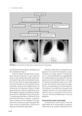 y/o afectación del hemitórax contralateral al
de la exploración (Fig. 5).
Antes de realizar la exploración es nece-
sario explicar al paciente en qué consiste la
técnica y qué sensaciones puede experimen-
tar durante la ejecución de las distintas manio-
bras. De este modo, la toracoscopia puede ser
muy bien tolerada con sólo anestesia local y
moderado consumo de analgésicos por vía
intravenosa. Es importante valorar el estado
general antes de indicar la exploración, pres-
tando especial atención a la presencia de hipo-
proteinemia o debilidad extrema del pacien-
te, edemas generalizados o infiltración de la
pared del hemitórax a explorar, y especial-
mente se debe ser muy cuidadoso con la pre-
sencia de tos intensa, ya que ésta puede difi-
cultar mucho la exploración y favorecer la
aparición de enfisema subcutáneo.
Siempre se debe hacer un estudio de coa-
gulación con recuento de plaquetas, requi-
riéndose un contaje superior a 60.000 por
mm3, y los tests habituales de coagulabilidad.
En nuestra experiencia los pacientes más peli-
grosos son los inmunodeprimidos, en los que
el recuento de plaquetas puede no ser refle-
jo claro del deterioro del estudio de coagu-
lación, y los portadores de cirrosis hepática.
No obstante, los problemas más graves de
sangrado durante una toracoscopia suelen
deberse más a un accidente (rotura de un
vaso por la pinza de biopsia) que a una coa-
gulopatía.
Entrenamiento para toracoscopia
Es importante conocer que la curva de
aprendizaje de la toracoscopia es especial-
mente lenta; así, nuestro rendimiento en la
44
 F. RODRÍGUEZ-PANADERO
FIGURA 5. Precauciones al seleccionar a pacientes para toracoscopia.
Coagulopatías graves Adherencias pleurales firmes
y extensas
Derrame pleural bilateral
(¡Cuidado con ascitis!)
Afectación pulmonar bilateral
Insuficiencia respiratoria grave
¡Mucho cuidado!
Pacientes muy tosedores
(¡¡Enfisema subcutáneo!!)
Pleura 224p 9/7/13 10:22 Página 44
 