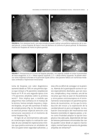 toma de biopsias con valor diagnóstico
aumentó desde un 70% en una primera épo-
ca (que incluyó a 96 pacientes neoplásicos)
hasta un 91% en una segunda época (con
174 pacientes añadidos sobre la primera
serie)(4). Esto implica que, a medida que
adquirimos más confianza en el manejo de
la técnica, hemos tomado mayores y mejo-
res biopsias, sin por ello aumentar el índice
de complicaciones (Fig. 6). De todos modos,
es esencial prestar especial atención a las
estructuras vasculares en el momento de
tomar biopsias (Fig. 7).
El logro de un entrenamiento adecuado
en toracoscopia implica la realización tute-
lada de una cantidad de exploraciones míni-
ma (que podría estimarse en alrededor de
50 si se quiere tener seguridad suficiente), y
esta cifra es difícil de conseguir en la prácti-
ca. Además de la participación activa en cur-
sos especialmente diseñados, que son esca-
sos, complicados y muy costosos, uno de los
recursos que más se usan en Escandinavia
y otros países centroeuropeos es el entre-
namiento toracoscópico en pacientes porta-
dores de neumotórax, en los que la intro-
ducción del trocar y la exploración de la
cavidad pleural es poco arriesgada. La eva-
luación toracoscópica del neumotórax está
bastante extendida en algunos países, y tie-
ne como finalidad adoptar la opción tera-
péutica más adecuada, dependiendo del tipo
de lesiones pulmonares encontradas (las cua-
les pueden variar desde un aspecto macros-
cópico normal hasta la presencia de grandes
ampollas de enfisema)(5).
45
PROCEDERES DE INTERVENCIÓN EN EL ESTUDIO DE LA ENFERMEDAD PLEURAL. TORACOSCOPIA MÉDICA
FIGURA 6. Con anestesia local y una sola entrada se puede realizar una perfecta exploración de la cavi-
dad pleural, y tomar biopsias de hasta 5 mm de diámetro.A) Linfoma en pleura parietal. B) Metástasis
masivas de neoplasia de mama en pleura parietal.
A B
FIGURA 7. Precauciones en la toma de biopsias pleurales, con especial cuidado en evitar la proximidad
de vasos sanguíneos. (L.S.I.= lóbulo superior izquierdo, L.I.I.= lóbulo inferior izquierdo). Se pueden obser-
var varios implantes tumorales en la pared del cayado aórtico. Este paciente falleció con numerosas metás-
tasis cerebrales e hipertensión intracraneal.
Pleura 224p 9/7/13 10:22 Página 45
 