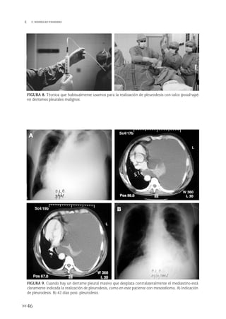 46
 F. RODRÍGUEZ-PANADERO
FIGURA 9. Cuando hay un derrame pleural masivo que desplaza contralateralmente el mediastino está
claramente indicada la realización de pleurodesis, como en este paciente con mesotelioma. A) Indicación
de pleurodesis. B) 42 días post- pleurodesis.
A
B
FIGURA 8. Técnica que habitualmente usamos para la realización de pleurodesis con talco (poudrage)
en derrames pleurales malignos.
Pleura 224p 9/7/13 10:22 Página 46
 