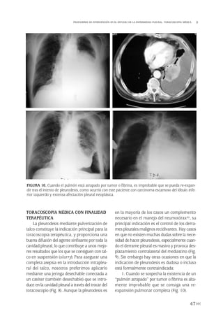 TORACOSCOPIA MÉDICA CON FINALIDAD
TERAPÉUTICA
La pleurodesis mediante pulverización de
talco constituye la indicación principal para la
toracoscopia terapéutica, y proporciona una
buena difusión del agente sinfisante por toda la
cavidad pleural, lo que contribuye a unos mejo-
res resultados que los que se consiguen con tal-
co en suspensión (slurry). Para asegurar una
completa asepsia en la introducción intrapleu-
ral del talco, nosotros preferimos aplicarlo
mediante una jeringa desechable conectada a
un catéter (también desechable) que se intro-
duce en la cavidad pleural a través del trocar del
toracoscopio (Fig. 8). Aunque la pleurodesis es
en la mayoría de los casos un complemento
necesario en el manejo del neumotórax(6), su
principal indicación es el control de los derra-
mes pleurales malignos recidivantes. Hay casos
en que no existen muchas dudas sobre la nece-
sidad de hacer pleurodesis, especialmente cuan-
do el derrame pleural es masivo y provoca des-
plazamiento contralateral del mediastino (Fig.
9). Sin embargo hay otras ocasiones en que la
indicación de pleurodesis es dudosa o incluso
está formalmente contraindicada:
1. Cuando se sospecha la existencia de un
“pulmón atrapado” por tumor o fibrina es alta-
mente improbable que se consiga una re-
expansión pulmonar completa (Fig. 10).
47
PROCEDERES DE INTERVENCIÓN EN EL ESTUDIO DE LA ENFERMEDAD PLEURAL. TORACOSCOPIA MÉDICA
FIGURA 10. Cuando el pulmón está atrapado por tumor o fibrina, es improbable que se pueda re-expan-
dir tras el intento de pleurodesis, como ocurrió con este paciente con carcinoma escamoso del lóbulo infe-
rior izquierdo y extensa afectación pleural neoplásica.
Pleura 224p 9/7/13 10:22 Página 47
 