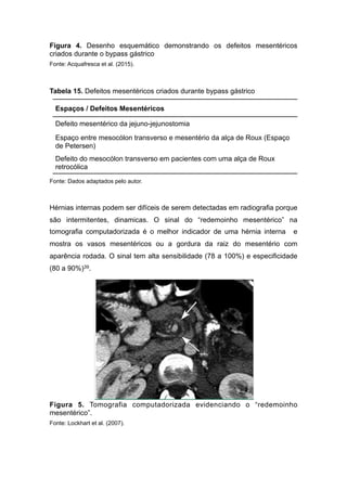 Figura 4. Desenho esquemático demonstrando os defeitos mesentéricos
criados durante o bypass gástrico
Fonte: Acquafresca et al. (2015).
Tabela 15. Defeitos mesentéricos criados durante bypass gástrico
Fonte: Dados adaptados pelo autor.
Hérnias internas podem ser difíceis de serem detectadas em radiografia porque
são intermitentes, dinamicas. O sinal do “redemoinho mesentérico” na
tomografia computadorizada é o melhor indicador de uma hérnia interna e
mostra os vasos mesentéricos ou a gordura da raiz do mesentério com
aparência rodada. O sinal tem alta sensibilidade (78 a 100%) e especificidade
(80 a 90%)39.
Figura 5. Tomografia computadorizada evidenciando o “redemoinho
mesentérico”.
Fonte: Lockhart et al. (2007).
Espaços / Defeitos Mesentéricos
Defeito mesentérico da jejuno-jejunostomia
Espaço entre mesocólon transverso e mesentério da alça de Roux (Espaço
de Petersen)
Defeito do mesocólon transverso em pacientes com uma alça de Roux
retrocólica
 